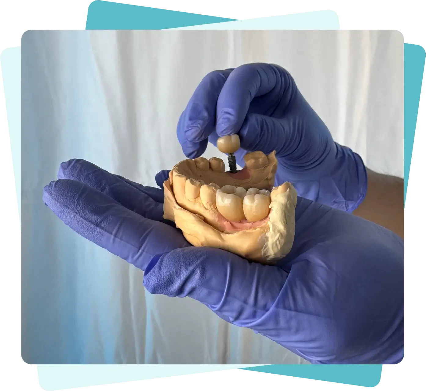 mymedic-implantes-neodent-grupo-straumann