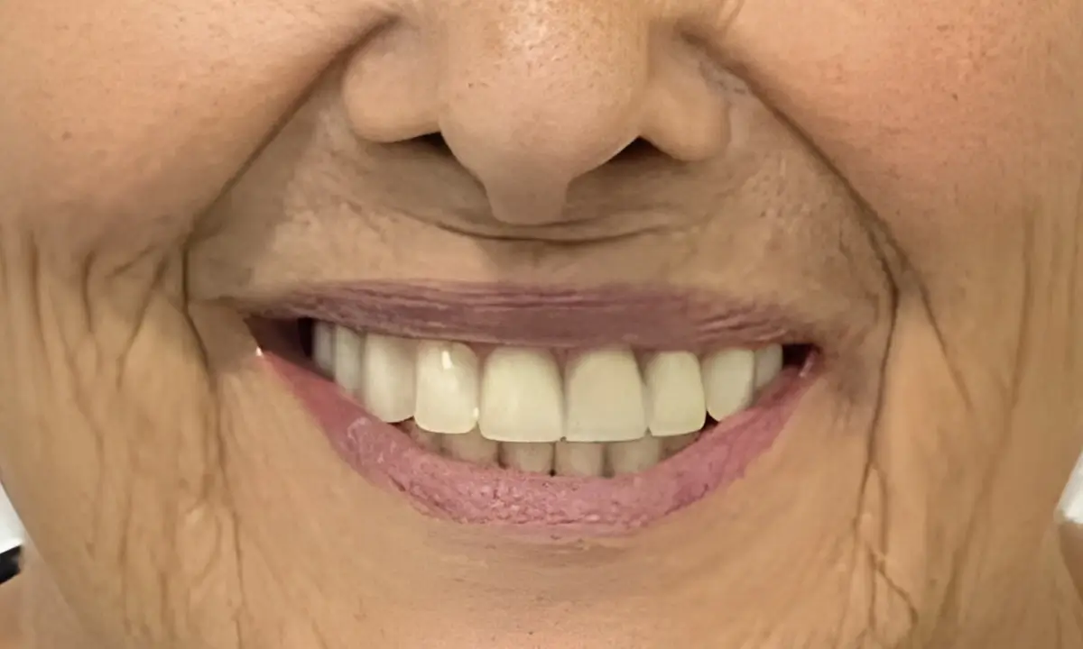 estética-dentária-depois-1