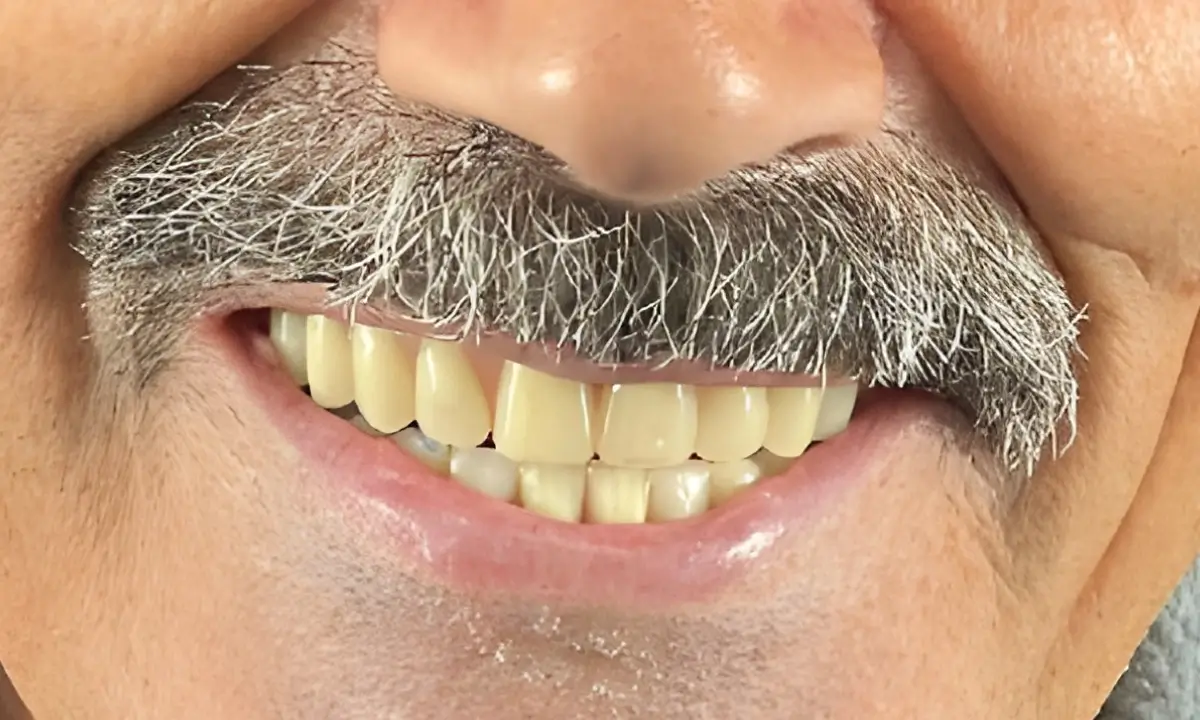 estética-dentária-depois-2